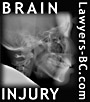 x-ray image of head and skull for Brain  Injury lawyers